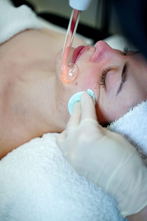High-frequency glass electrode treatment for acne-prone skin